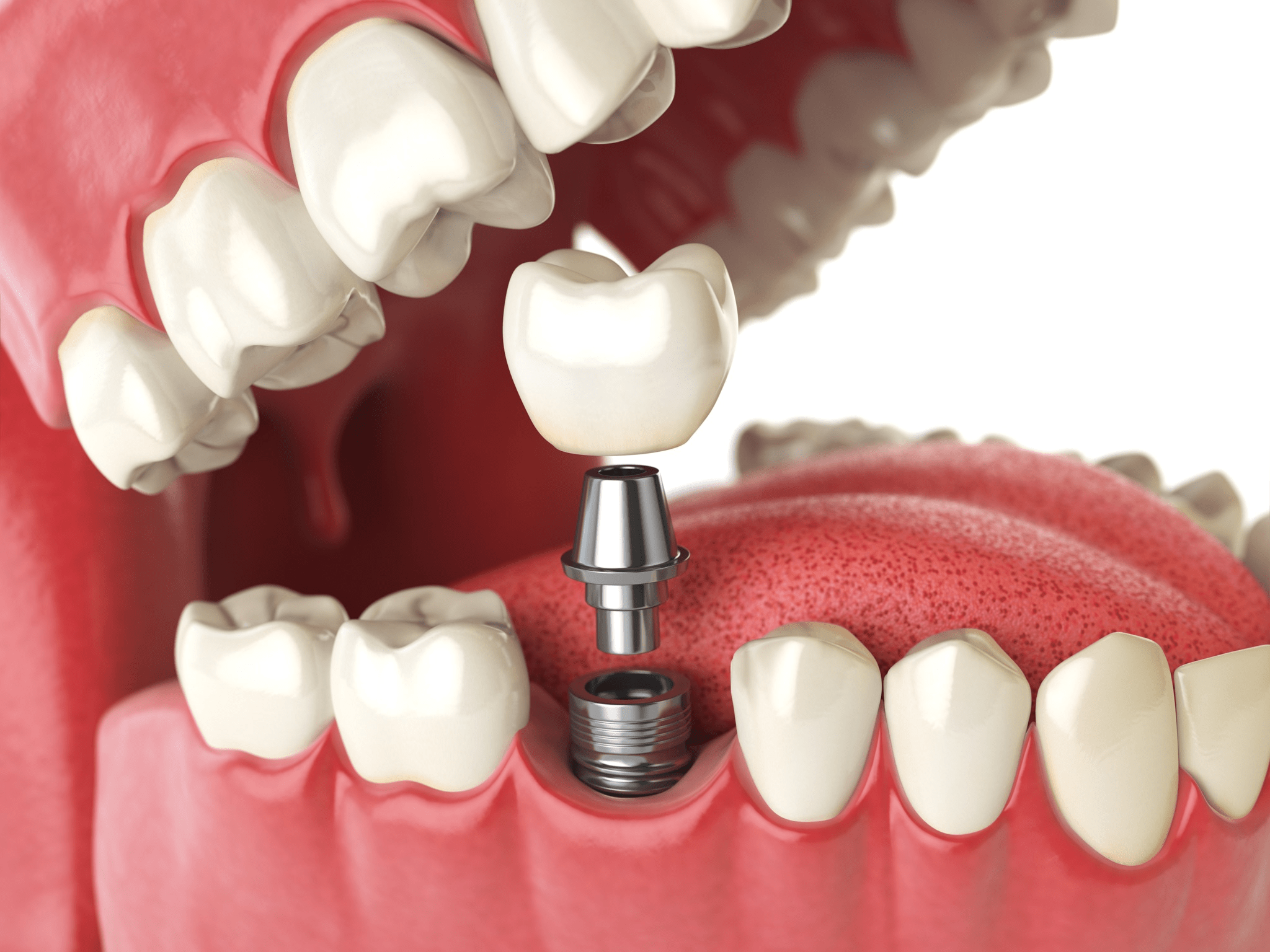 Veneers Vs Implants Whats The Difference