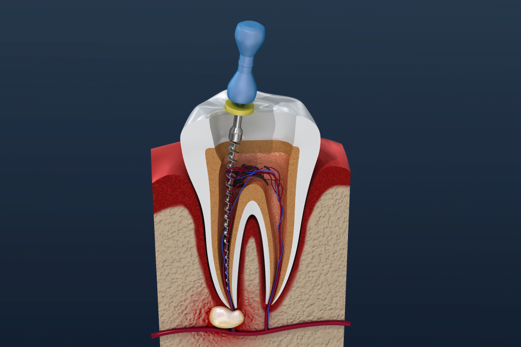 Benefits-of-a-Root-Canal-Treatment